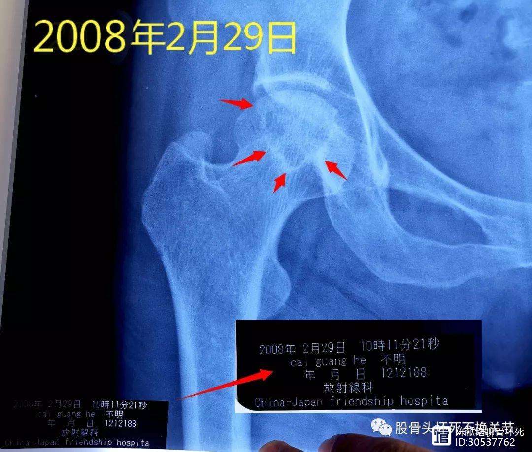 乐山人工骨头医保报销多少(人工骨头医保报销多少比例)